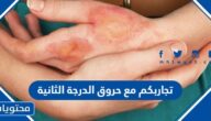 تجاربكم مع حروق الدرجة الثانية