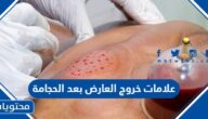 علامات خروج العارض بعد الحجامة