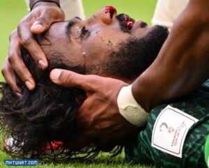 تفاصيل اصابة ياسر الشهراني لاعب المنتخب السعودي في كاس العالم