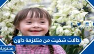 حالات شفيت من متلازمة داون