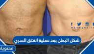 شكل البطن بعد عملية الفتق السري