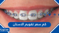 كم سعر تقويم الاسنان في السعودية 2025