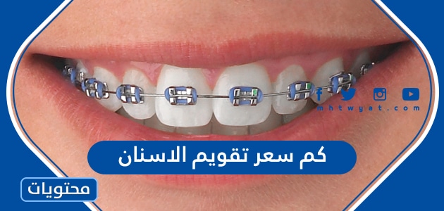كم سعر تقويم الاسنان في السعودية 2023