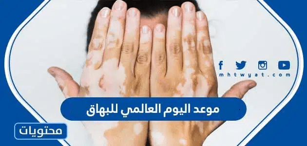 موعد اليوم العالمي للبهاق 2025